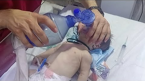 HIE Grade 3 | No Response & Gasping | Critical Case in NICU