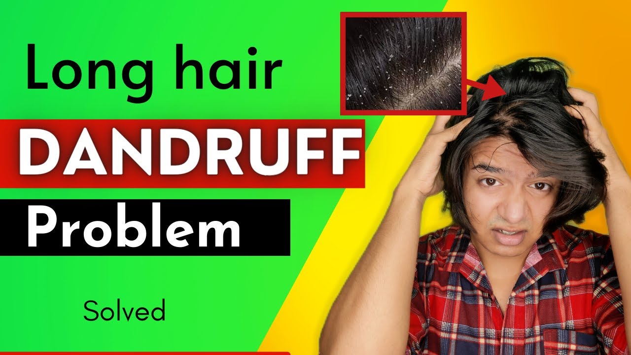 Easy & Simple Way to Remove Dandruff Dandruff kaise hataye Dandruff