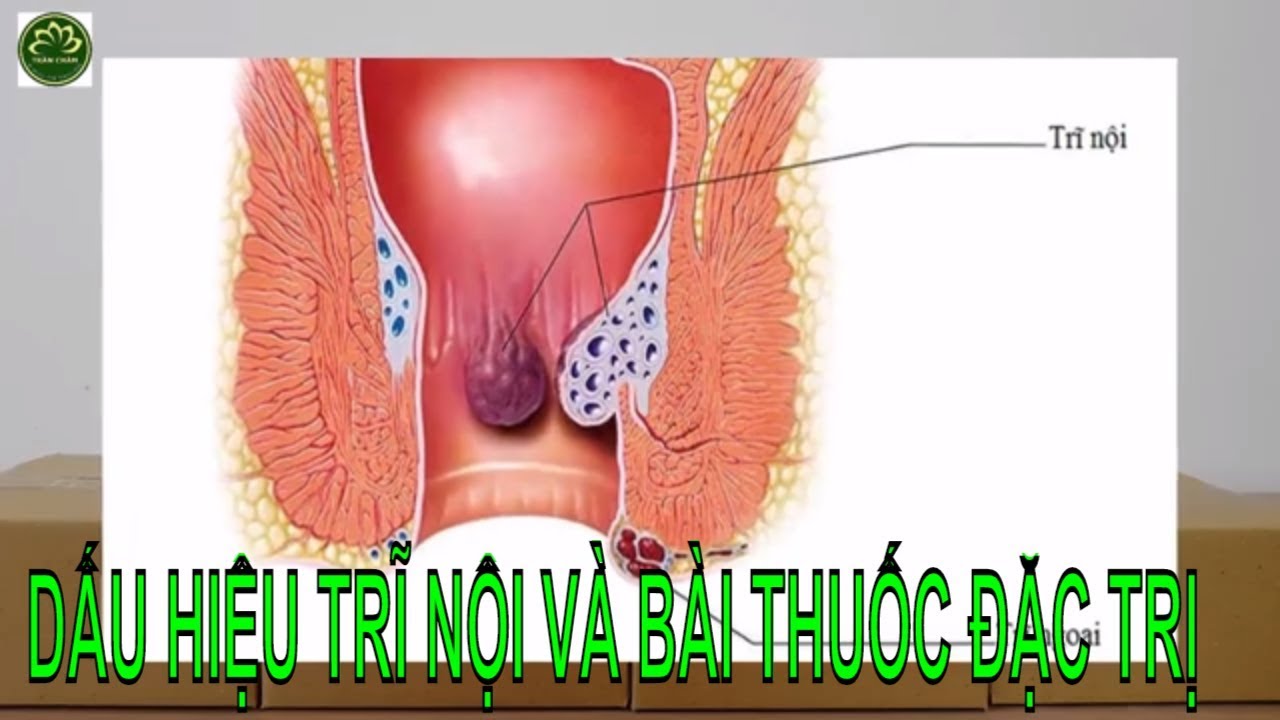 Dấu hiệu bệnh trĩ nội và bài thuốc đặc trị
