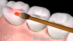 Laser dental treatment of gum disease dentists and dental care sydney castle hill  Call 02 9659 1200 