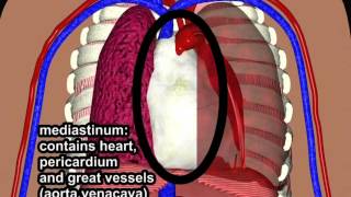 Hemothorax due to aortic rupture in aortic dissection by Cal Shipley, M.D.