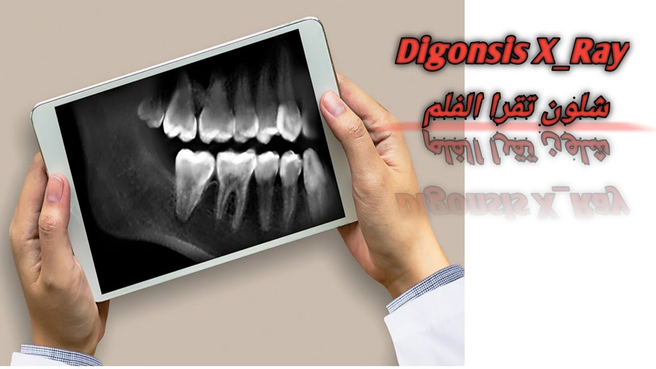 Digonsis X_Ray  شلون تشخص فلم ؟؟