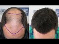 Fue hair transplant 4766 grafts nw v by dr juan couto  fuexpert clinic madrid spain