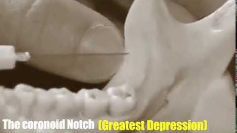 Injection  technique for Inferior Alveolar Nerve Block (IANB)