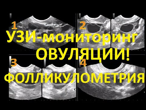 🔎Узи-мониторинг ОВУЛЯЦИИ 💥– Фолликулометрия. Признаки ОВУЛЯЦИИ на УЗИ для планирующих БЕРЕМЕННОСТЬ!