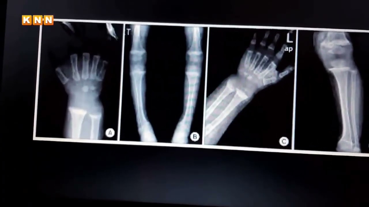 ئێسکە نەرمە و پوکانەوەی ئێسک هۆکار و چارەسەر