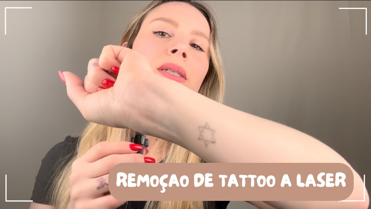 REMOÇÃO DE TATUAGEM A LASER - MINHA EXPERIÊNCIA (VALE A PENA? DÓI? VALOR)