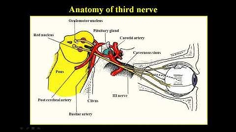 A Class On PARALYTIC SQUINT By Vivekanand Dept Of Ophthalmology