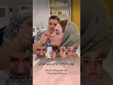 چهار ماه بعد از جراحی بینی گوشتی 