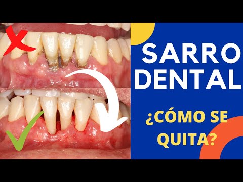 Huecos entre los dientes despues de una limpieza