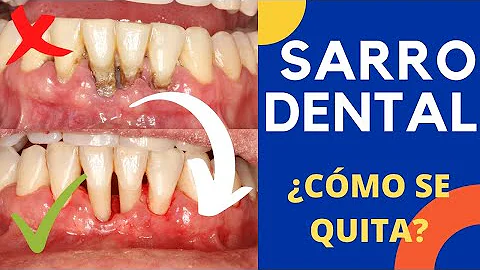 Como tirar o cálculo dental?