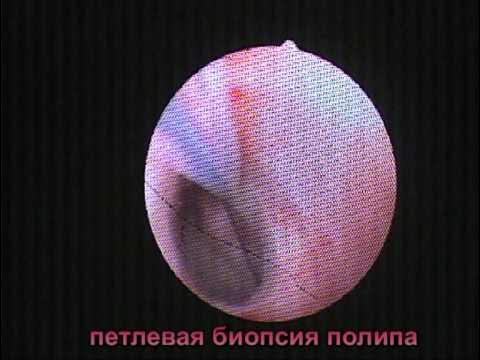 Пункционная биопсия шейки матки. Биопсия матки видео. Петлевая электроэксцизия шейки матки. Биопсия матки видео. Операция гистерорезектоскопия.