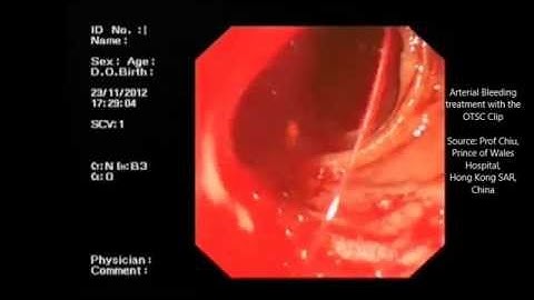 Management of arterial bleeding using Ovesco OTSC System