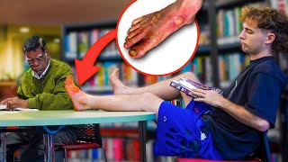 INFECTED FOOT PRANK