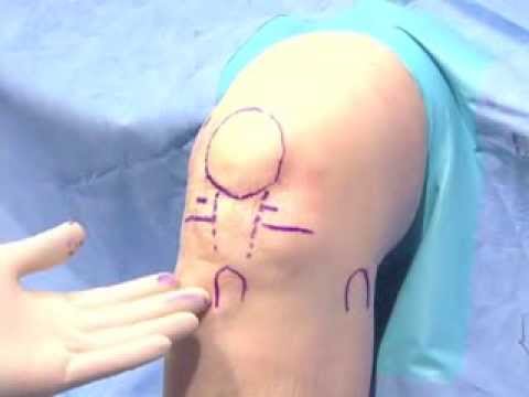 Arthroscopic Knee Surgery Video Part 2: Surface Anatomy & Placement | Albuquerque Orthopedic Surgeon
