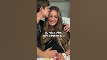 My face BEFORE & DURING PREGNANCY #taylorandsoph #family #couple #marriage #baby #funny #shorts