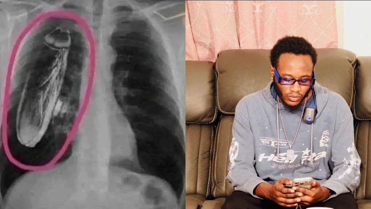 aga story gatoya:umurwayi yagiye kubitaro agiye gucyishwa mucyuma maze basanga ikinyenzi🪳 mubihaha😭💔