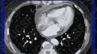 Chest CT: Cardiac Findings [Basic Radiology]