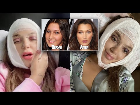 Video: How To Decide On Plastic Surgery: Personal Experience