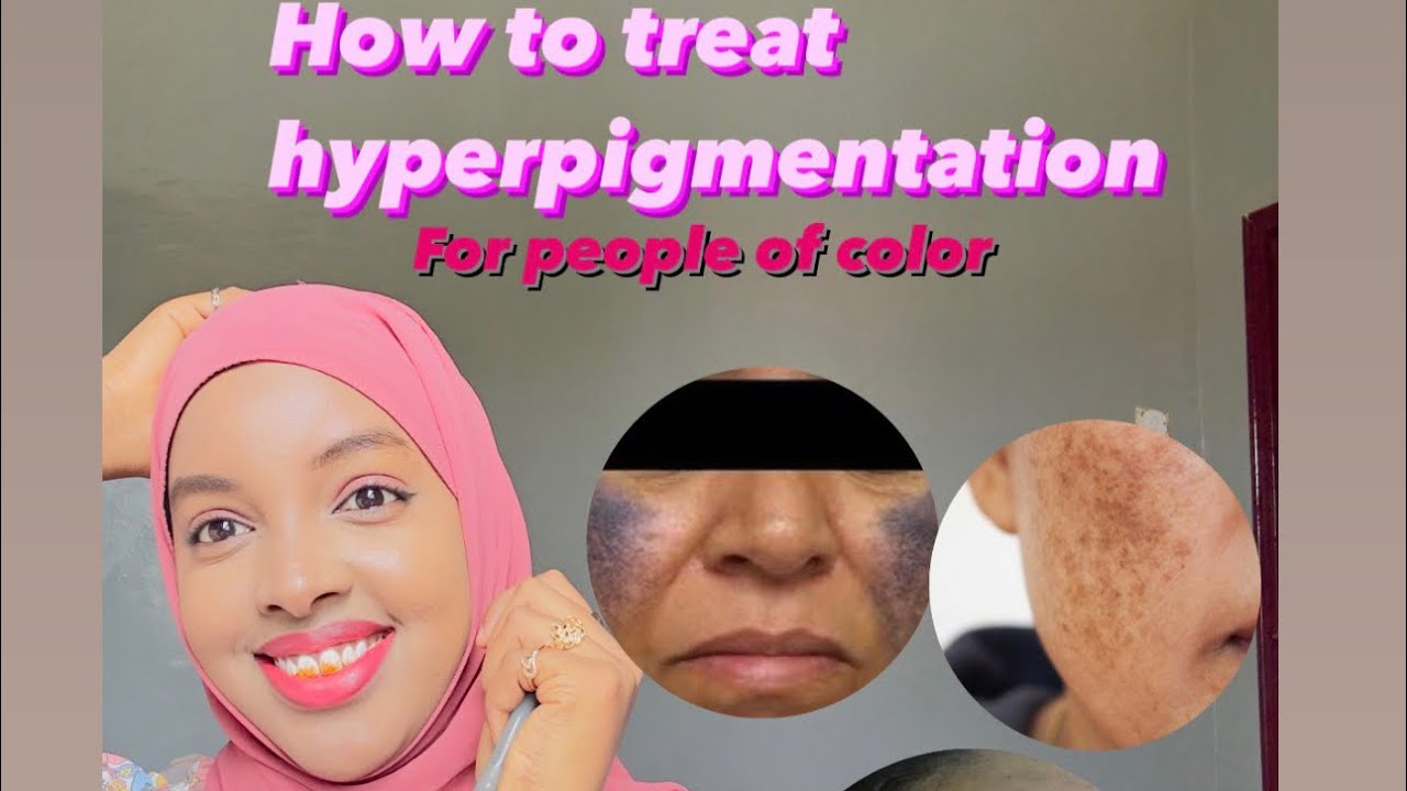 SIDEED ISKAGA DAWAYN LAHAYD HAARAHA MAQAARKA KU DHAGA ( HOW TO TREAT HYPERPIGMENTATION ) |DR.asmaidi