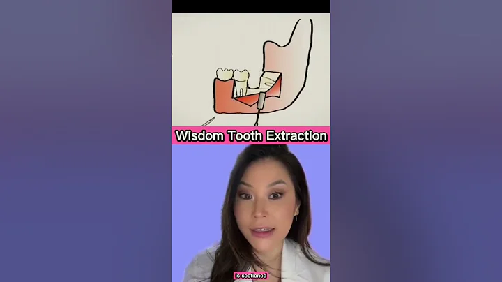 Dentist explains Wisdom Tooth Surgical Extraction #shorts