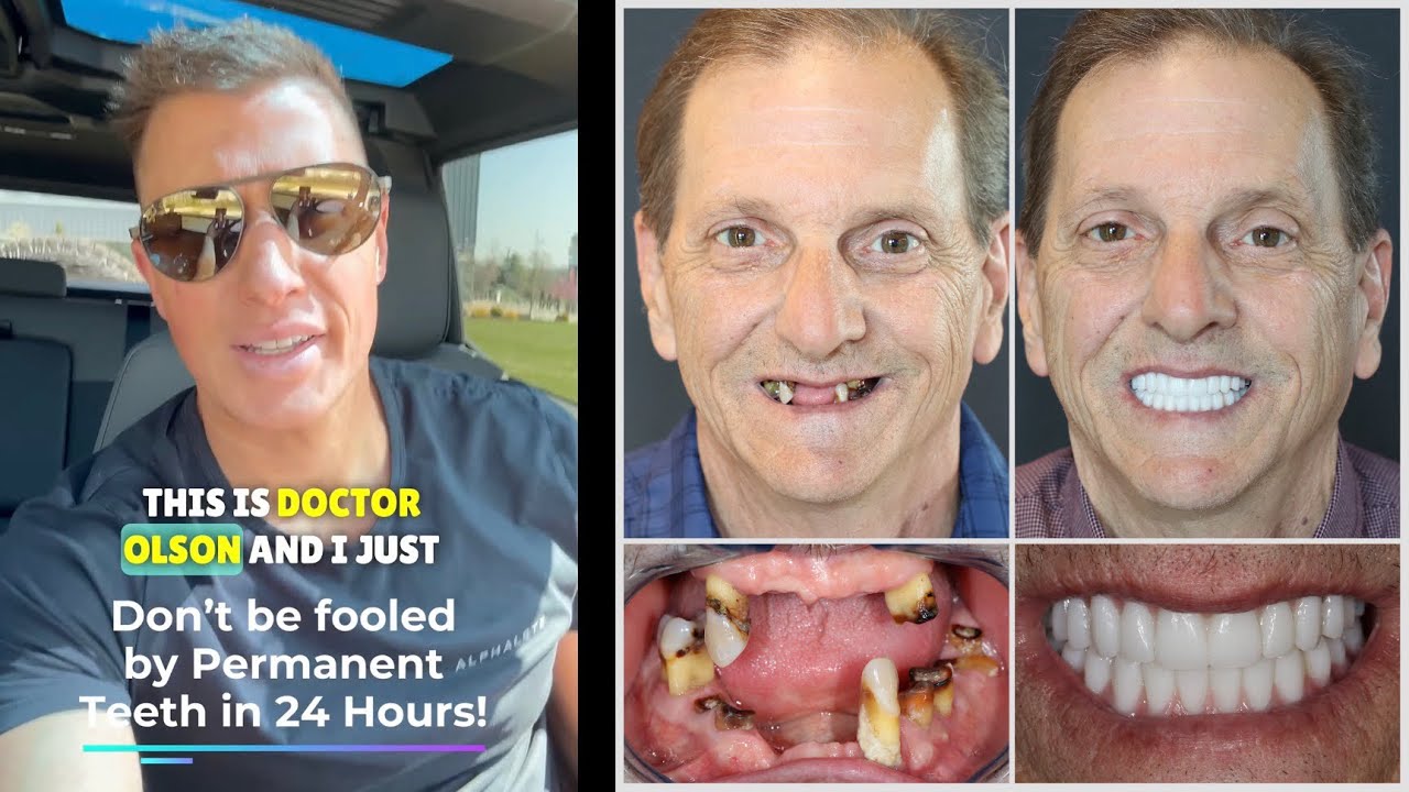 Outline Video Don’t be fooled by PERMANENT TEETH IN 24 HOURS with All-On-4 Dental Implants!