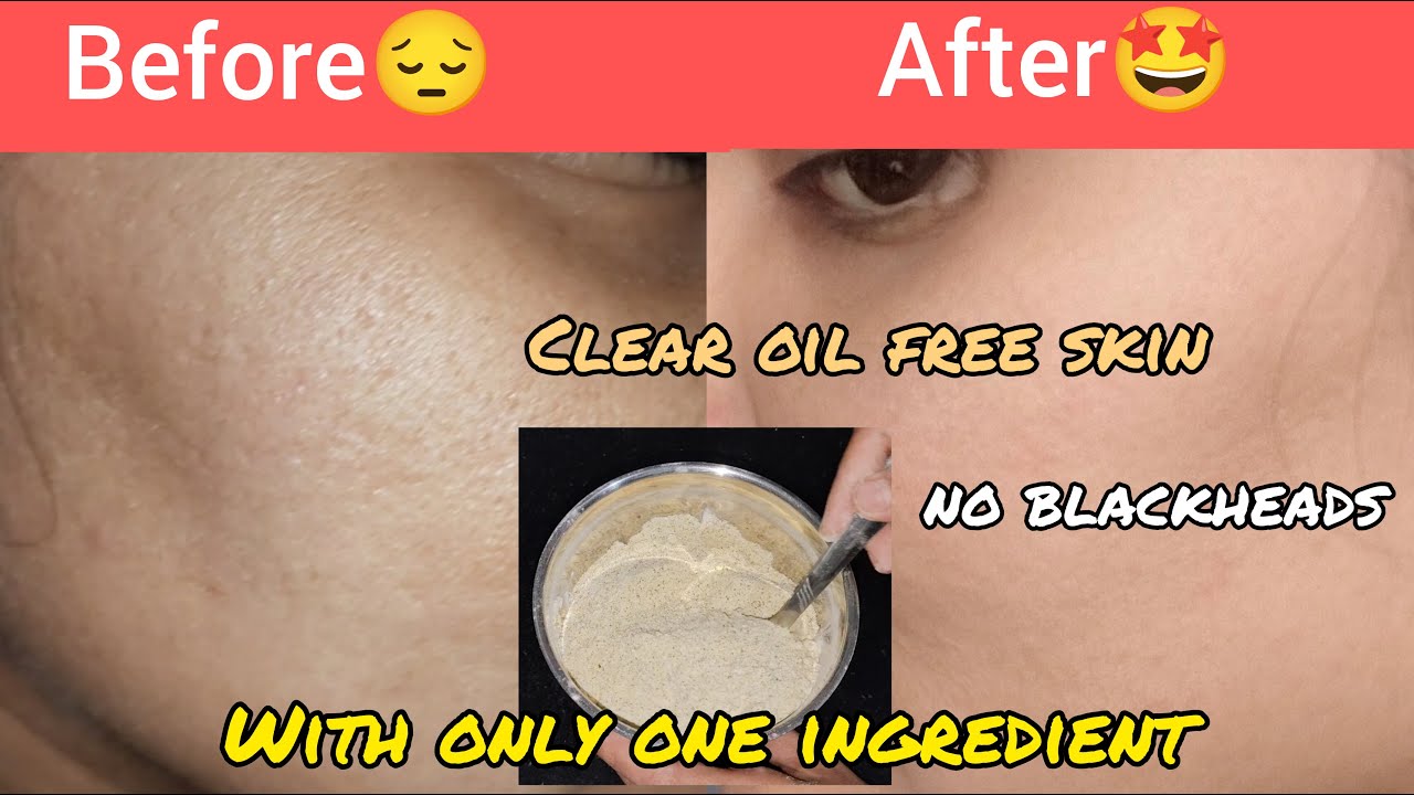 Remove Blackheads with only one ingredient ಬ್ಲಾಕ್ಹೆಡ್ಸ್ಗೆ ಸರಳ ಪರಿಹಾರ