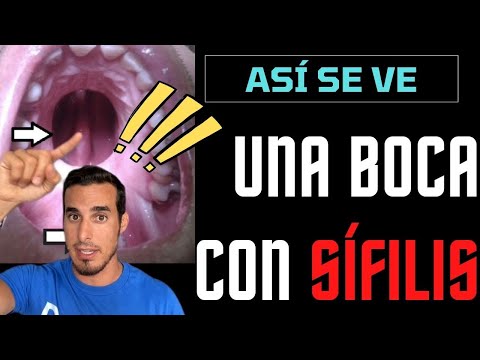 Vídeo: Les infeccions per fongs es transmeten sexualment?