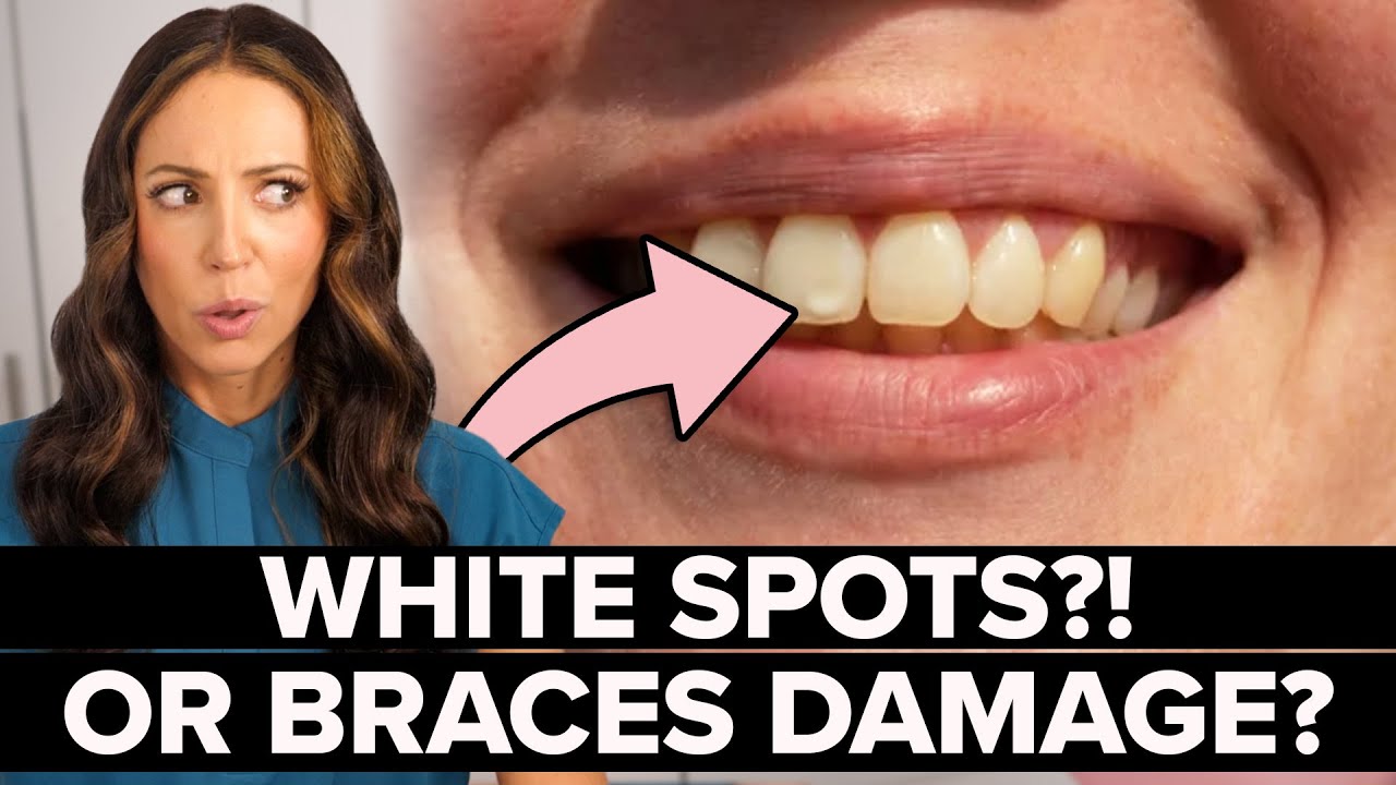White Spots from Braces? Here’s the Truth About Decalcification