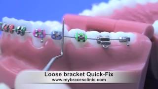 Loose braces bracket Quick Fix