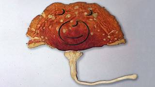 Download Lagu A Man Macrodosed Forest-Picked Mushrooms. This Is What Happened To His Organs. MP3 Download Lagu A Man Macrodosed Forest-Picked Mushrooms. This Is What Happened To His Organs. MP3