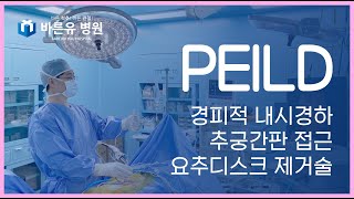 PEILD 경피적 내시경하 추궁간판 디스크 절제술 (협착증 내시경 감압술 / PEILD)