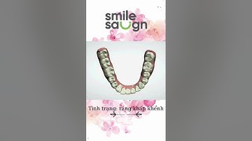 Phác đồ điều chỉnh răng khấp khểnh - SmileSalign