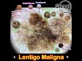 Lentigo Maligna Melanoma