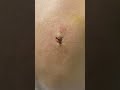Open cyst to sutured