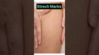 Best Cream For Stretch Marks | #doctorrajni #skincare #stretchmarks #stretchmarkscream #antiaging