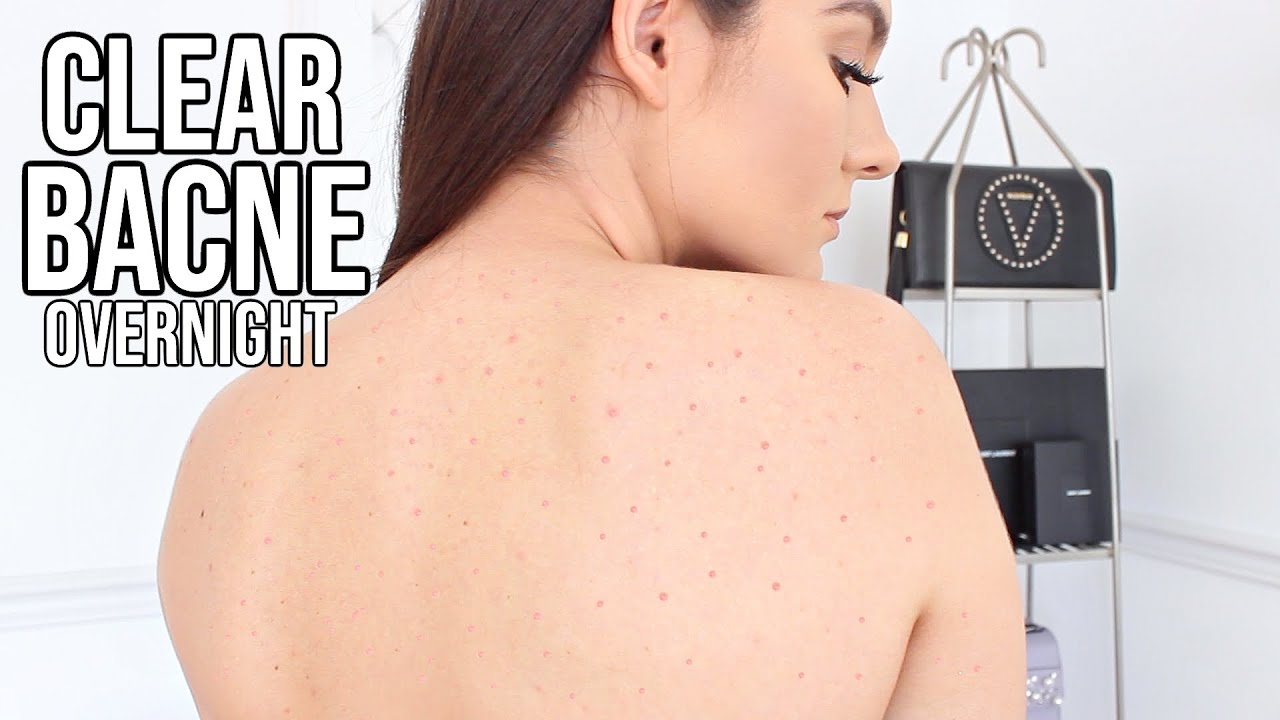 How To Get Rid Of BACK ACNE OVERNIGHT !! 