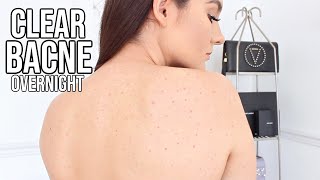 Today i am sharing my tips on how to get rid of back acne and body
acne! cleared up bacne! pimple life hacks & bacne treatments products
used here: ...