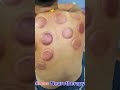 Back pain relief cupping therapy session #neurotherapy #digestivehealth #cupping #cuppingtherapy