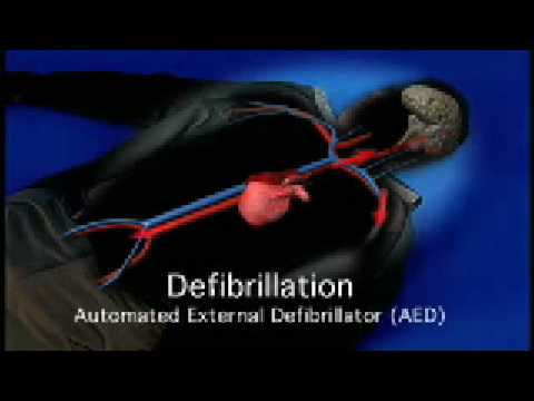 Project ADAM - Chapter 2 of 4: Understanding Sudden Cardiac Arrest (SCA)
