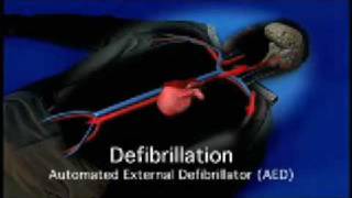 Project ADAM - Chapter 2 of 4: Understanding Sudden Cardiac Arrest (SCA)