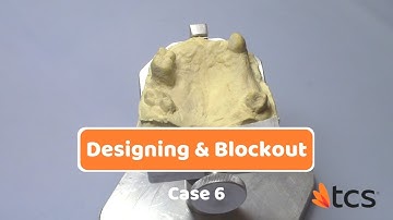 Designing & Blockout Case 6 - Great Story, Happy Patient