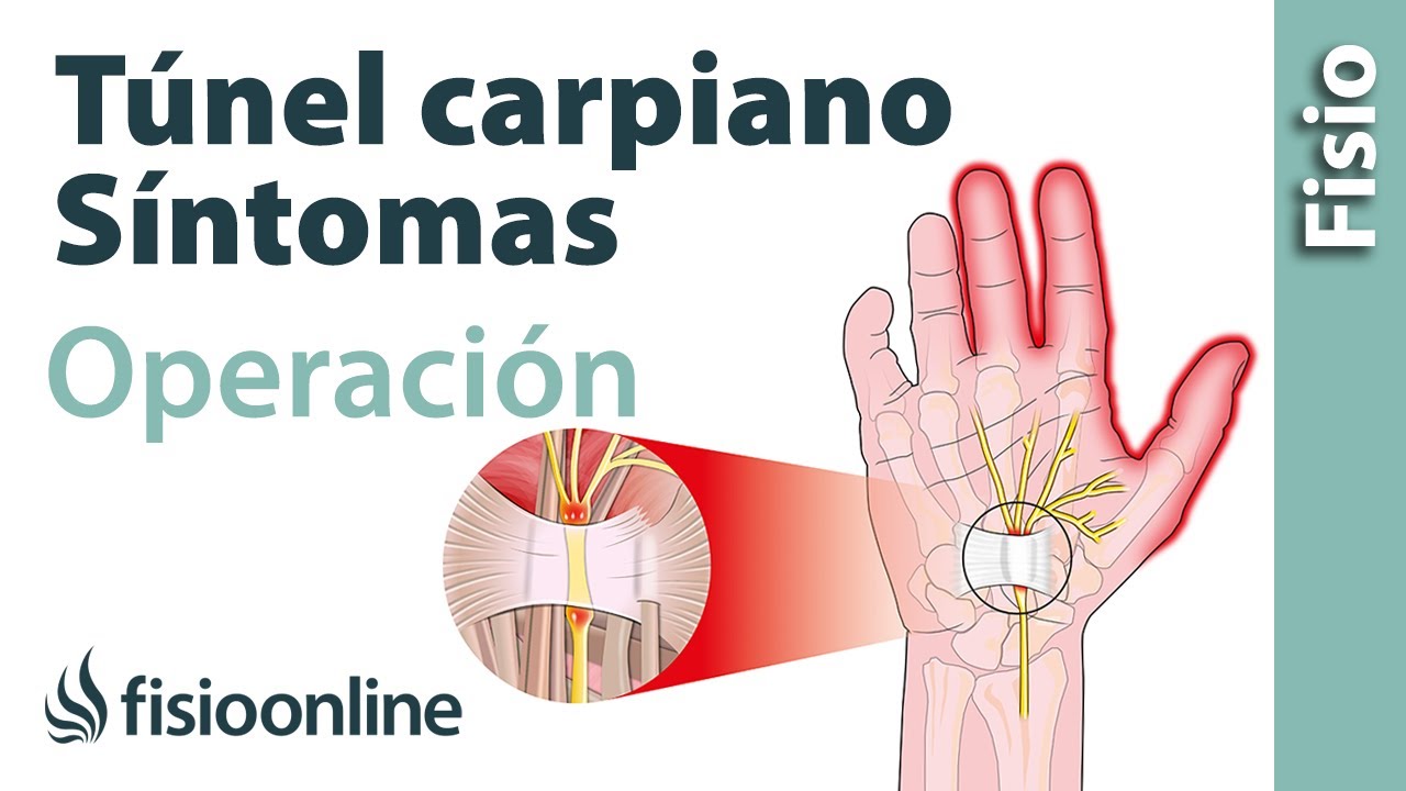 13 Mitos del Síndrome del túnel carpiano: Todo lo que debes saber