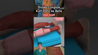 Cangkok kulit Paha ke Betis (Skin Graft) #skin #plasticsurgeon