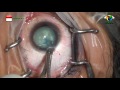 Cataract surgery fast phaco 1288