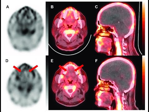 Single Photon Emission Computed Tomography (SPECT Scan) Application in ...