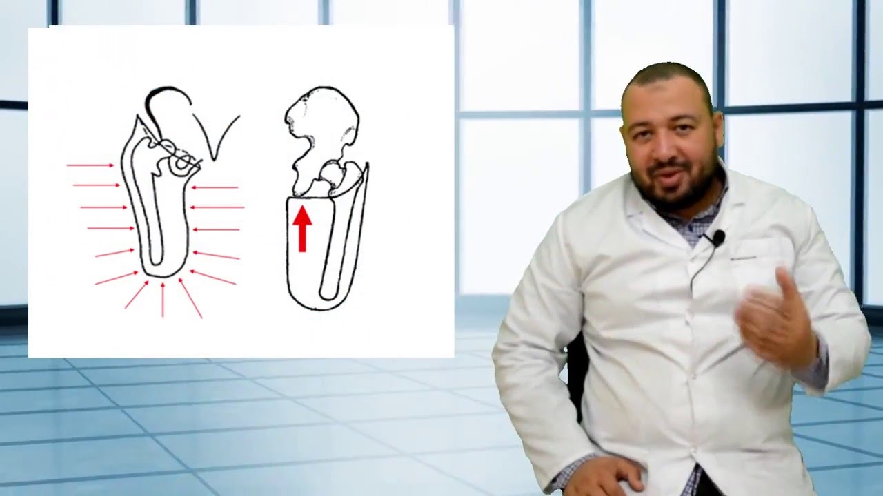 انواع الأطراف الصناعية و أجهزة الشلل- اطراف صناعية حديثة  - م/حسن فضل