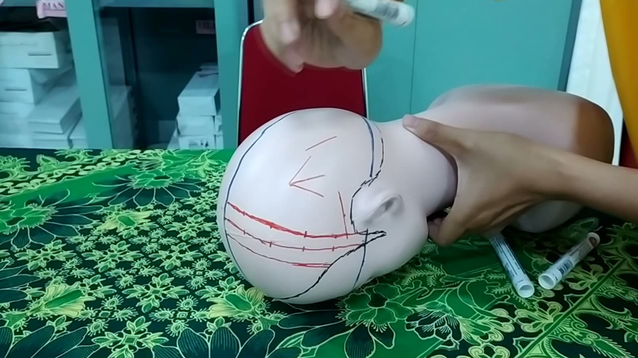 Jiao's scalp acupuncture