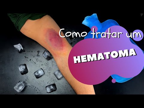 Vídeo: 3 maneiras de se livrar de hematomas