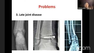 Distal Tibia and Transitional Fractures